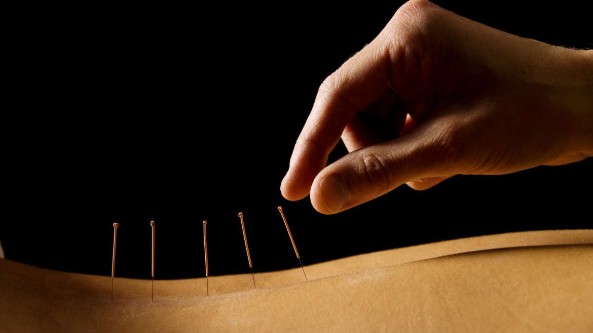 Acupuncture