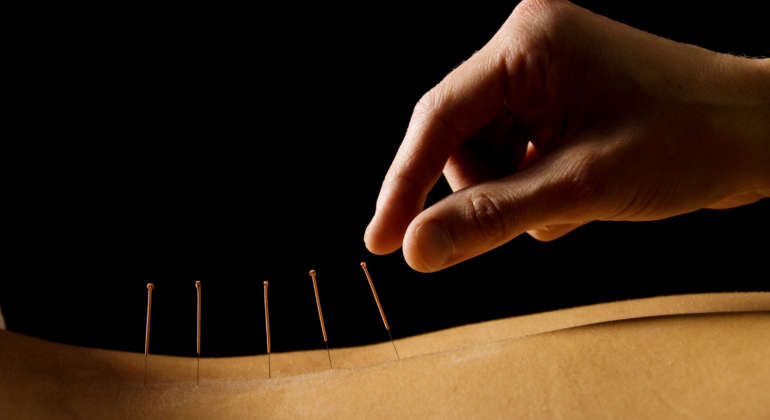 Brevard County Acupuncture
