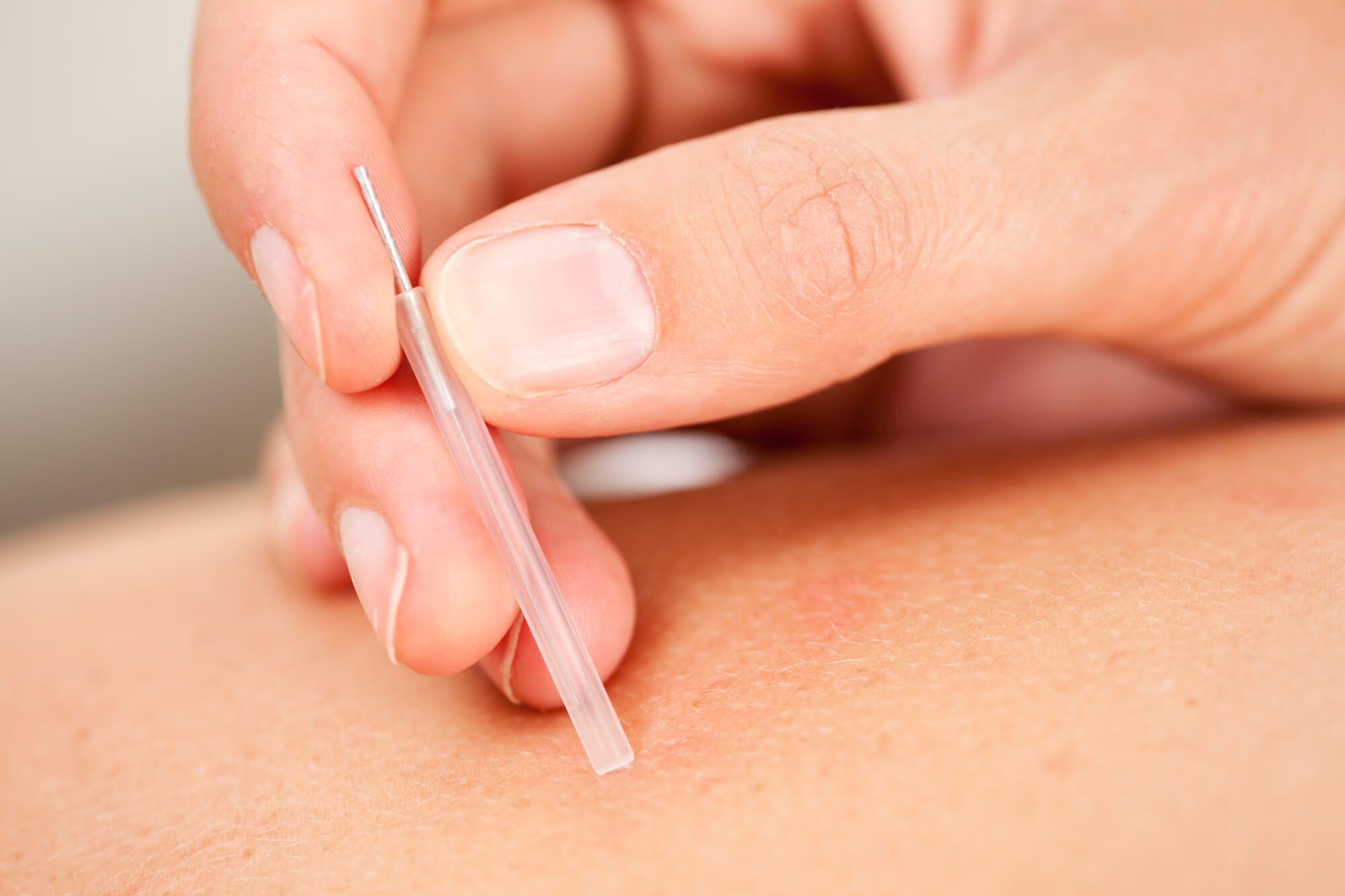 Acupuncture being performed in Brevard County