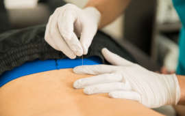 Dry needling in brevard county, fl