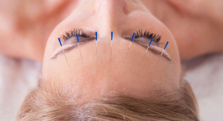 Facial Rejuvination Acupuncture in Brevard County, FL